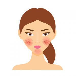 How to Recognize and Treat Your Rosacea