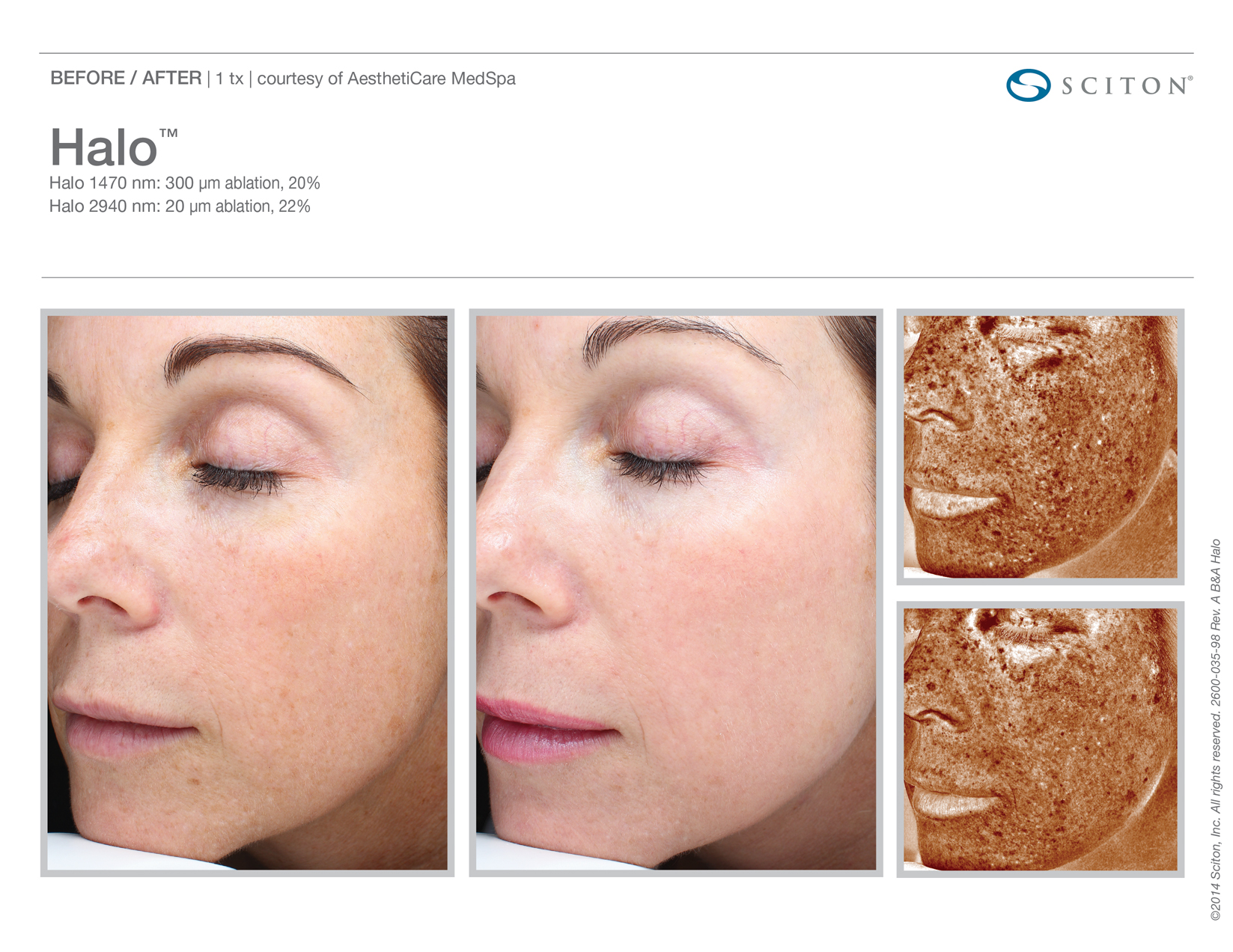 Prep Your Skin This Fall with Sciton® Laser Resurfacing Treatments - Aya  Skin Care