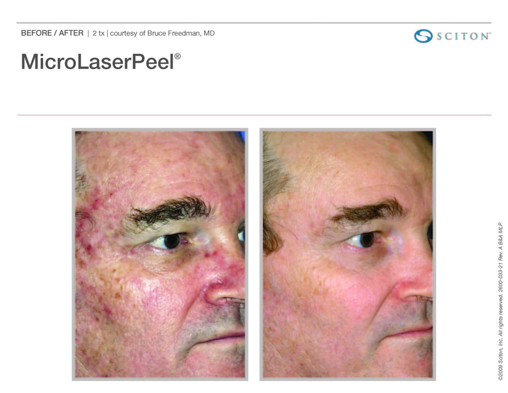 microlaserpeel before and after