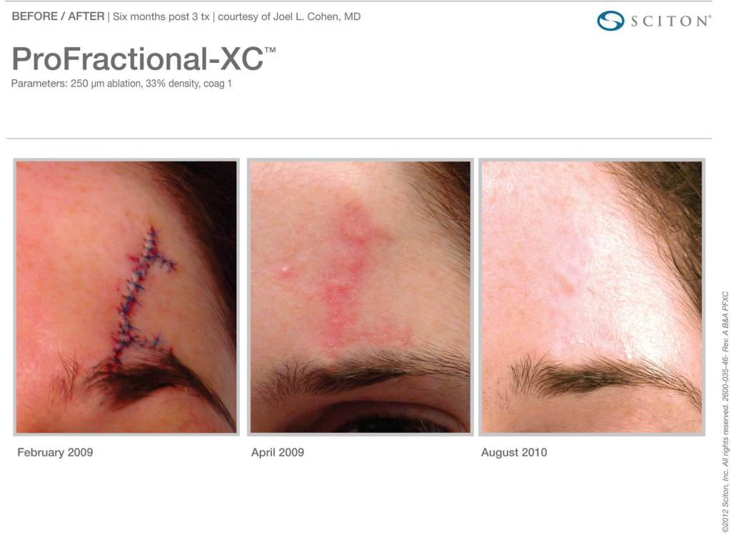 scar revision before and after
