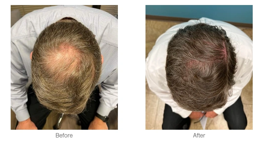 Before and after photos of Exosome treatment at AYA